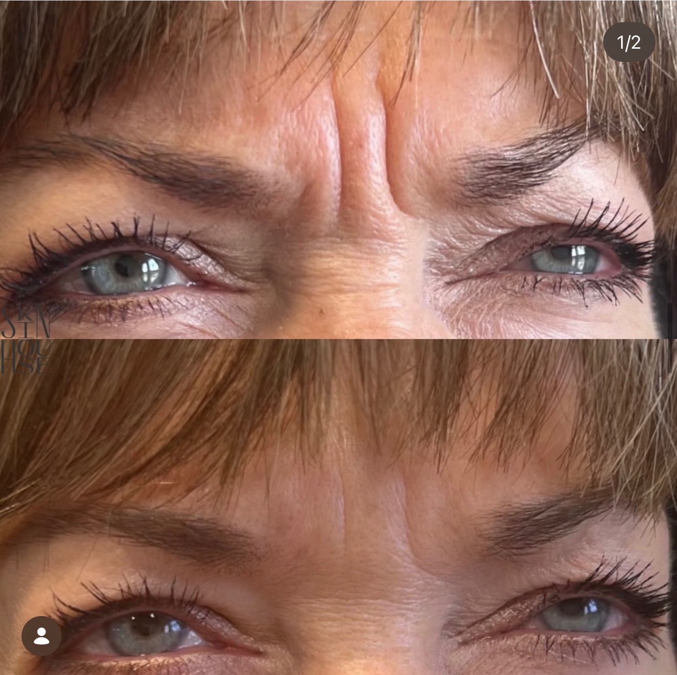 Before and after Botox for glabella frown lines at Skin House Birmingham MI