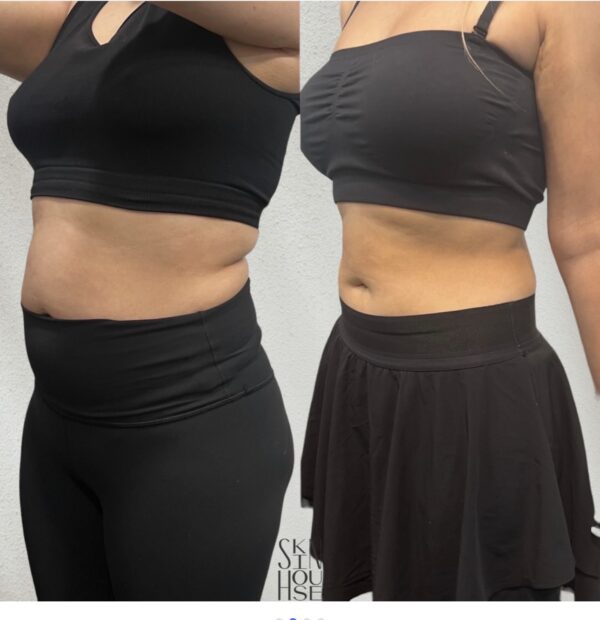 Medical weight loss before and after results Birmingham MI