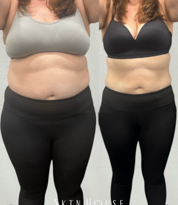 Medical weight loss before and after results Birmingham MI