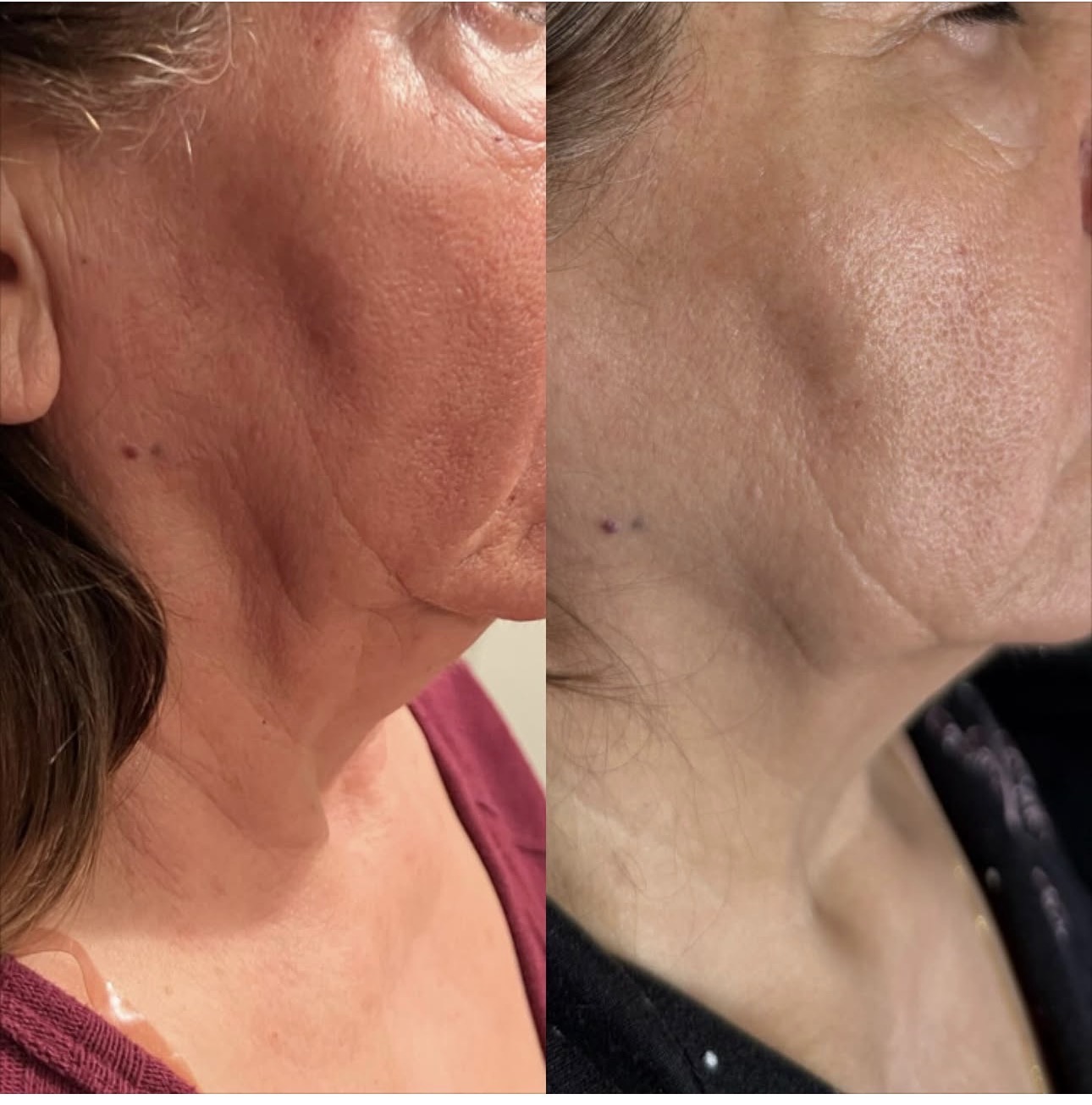 Morpheus 8 before and after jawline and neck tightening results at Skin House Birmingham MI