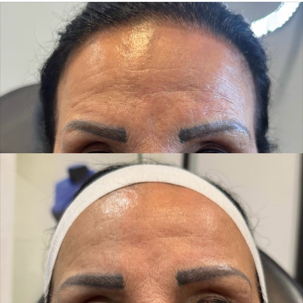 Morpheus 8 before and after forehead skin texture improvement at Skin House Birmingham MI