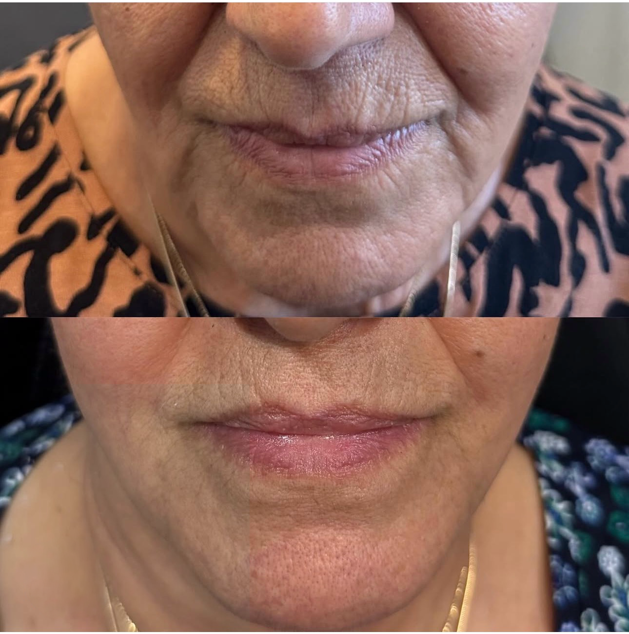 Morpheus 8 before and after lower face rejuvenation results at Skin House Birmingham MI
