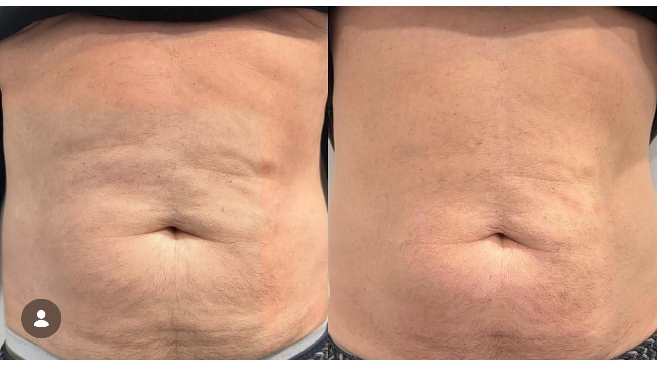 Morpheus 8 before and after abdomen skin tightening results at Skin House Birmingham MI
