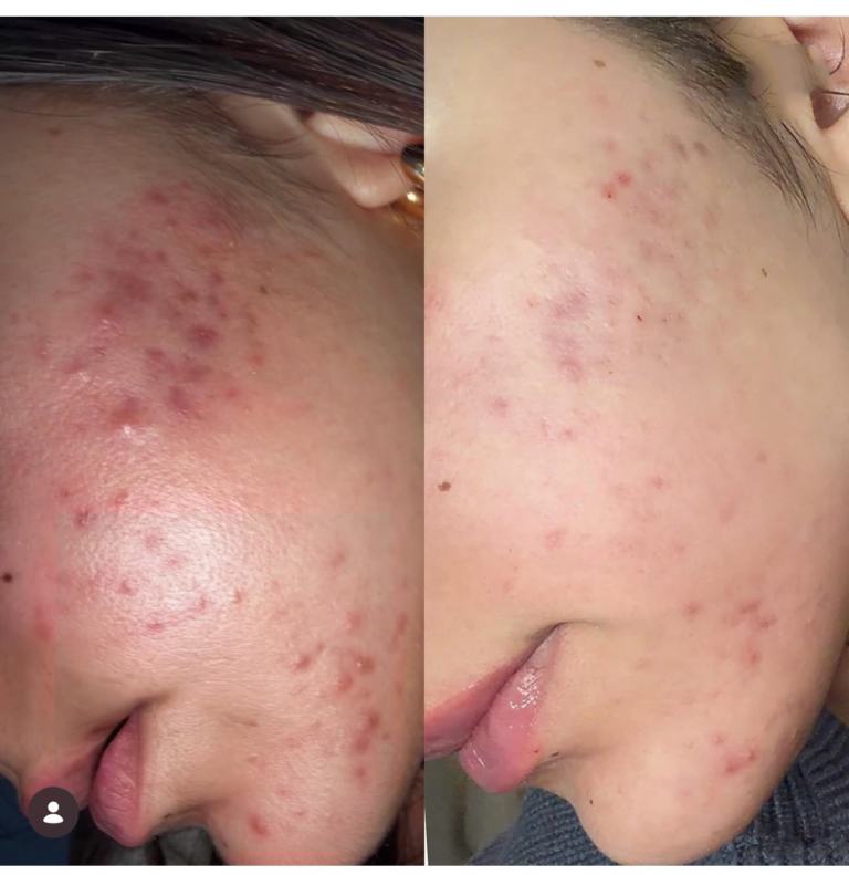 Microneedling before and after - acne scarring improvement