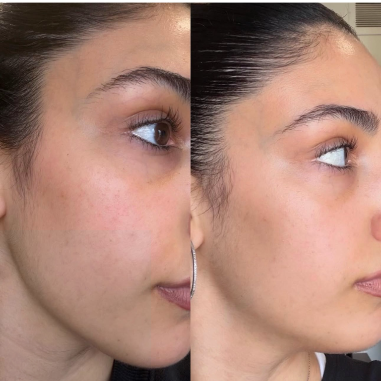 Microneedling before and after - skin texture and tone