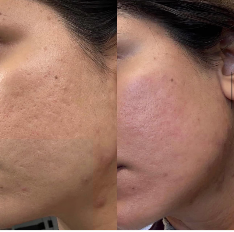Microneedling before and after - pore refinement