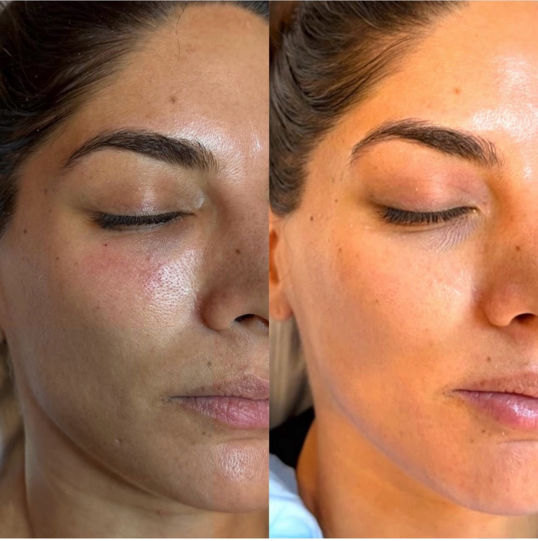 Microneedling before and after - overall skin rejuvenation