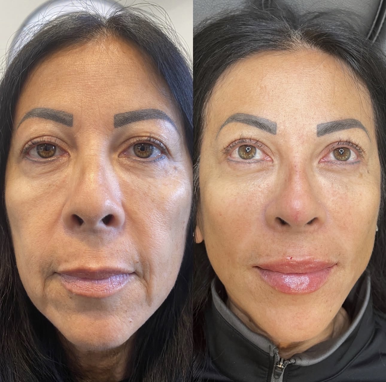 Facial rebalancing before and after — Skin House Birmingham