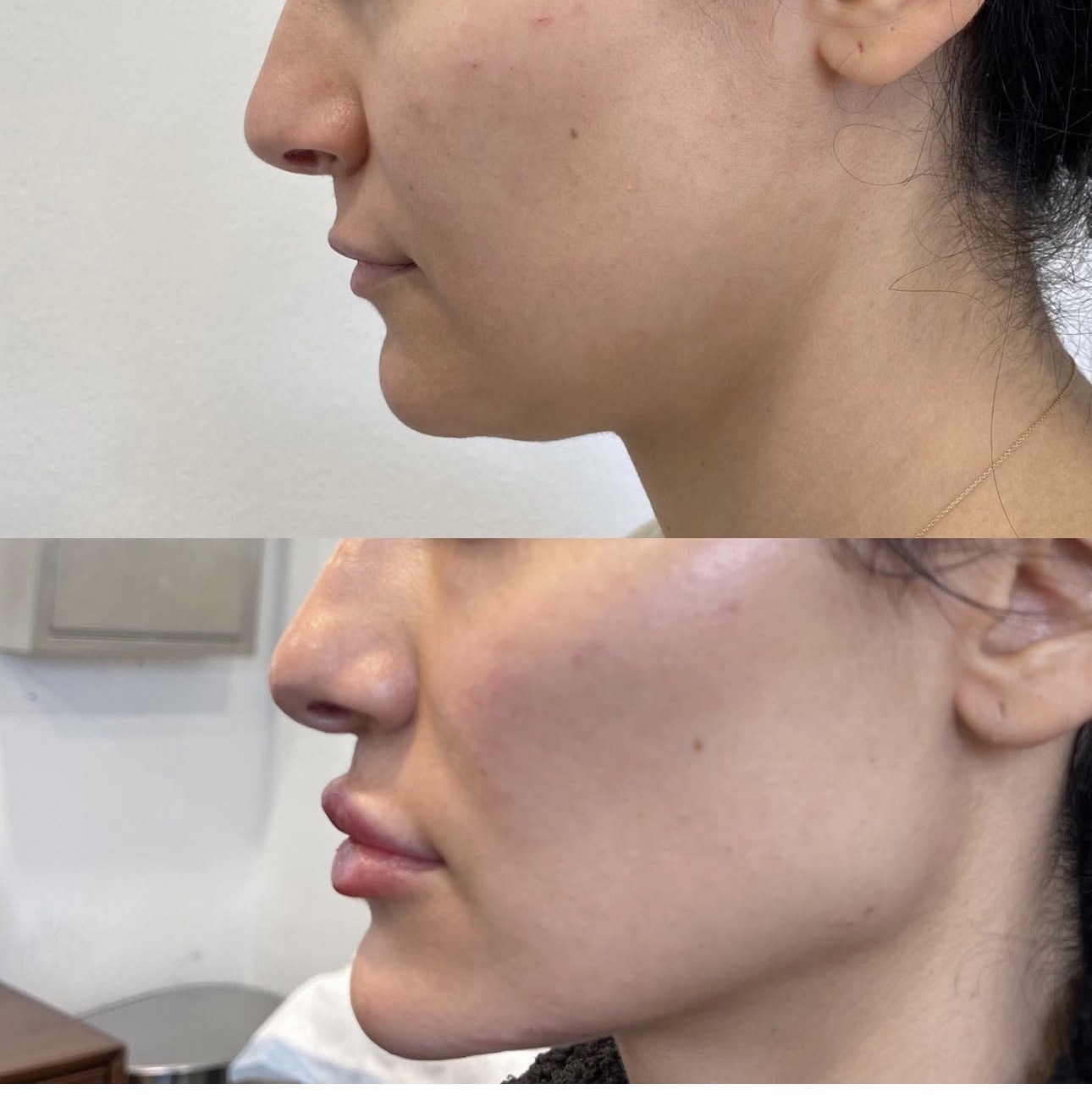 Jaw filler before and after — Skin House Birmingham