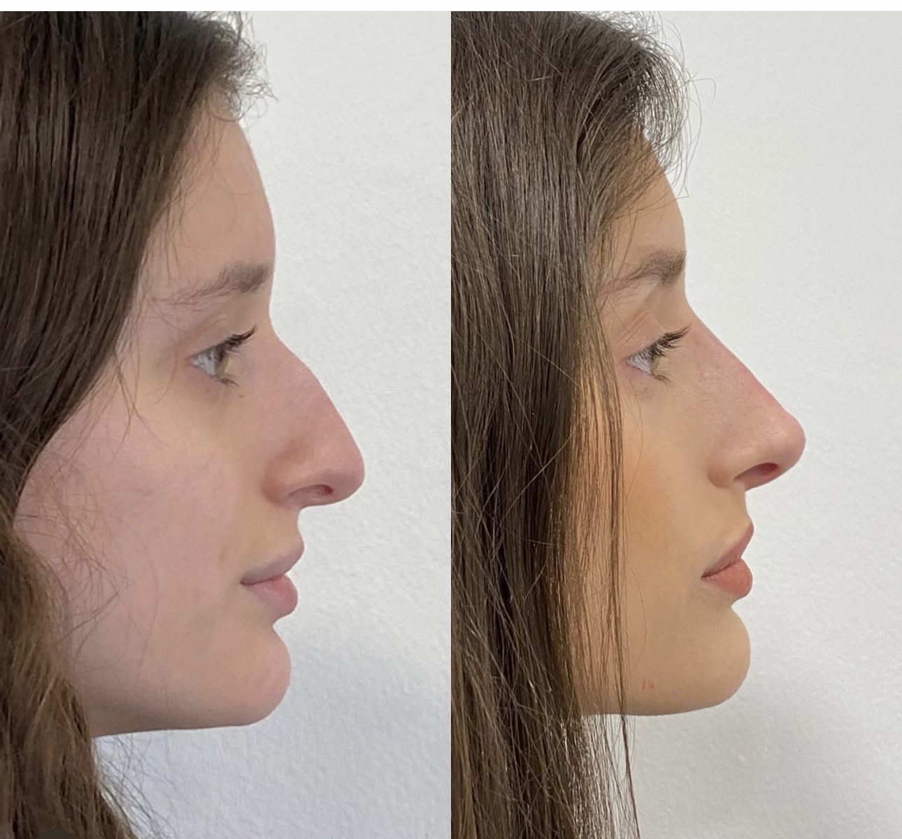 Non-surgical rhinoplasty before and after — Skin House Birmingham
