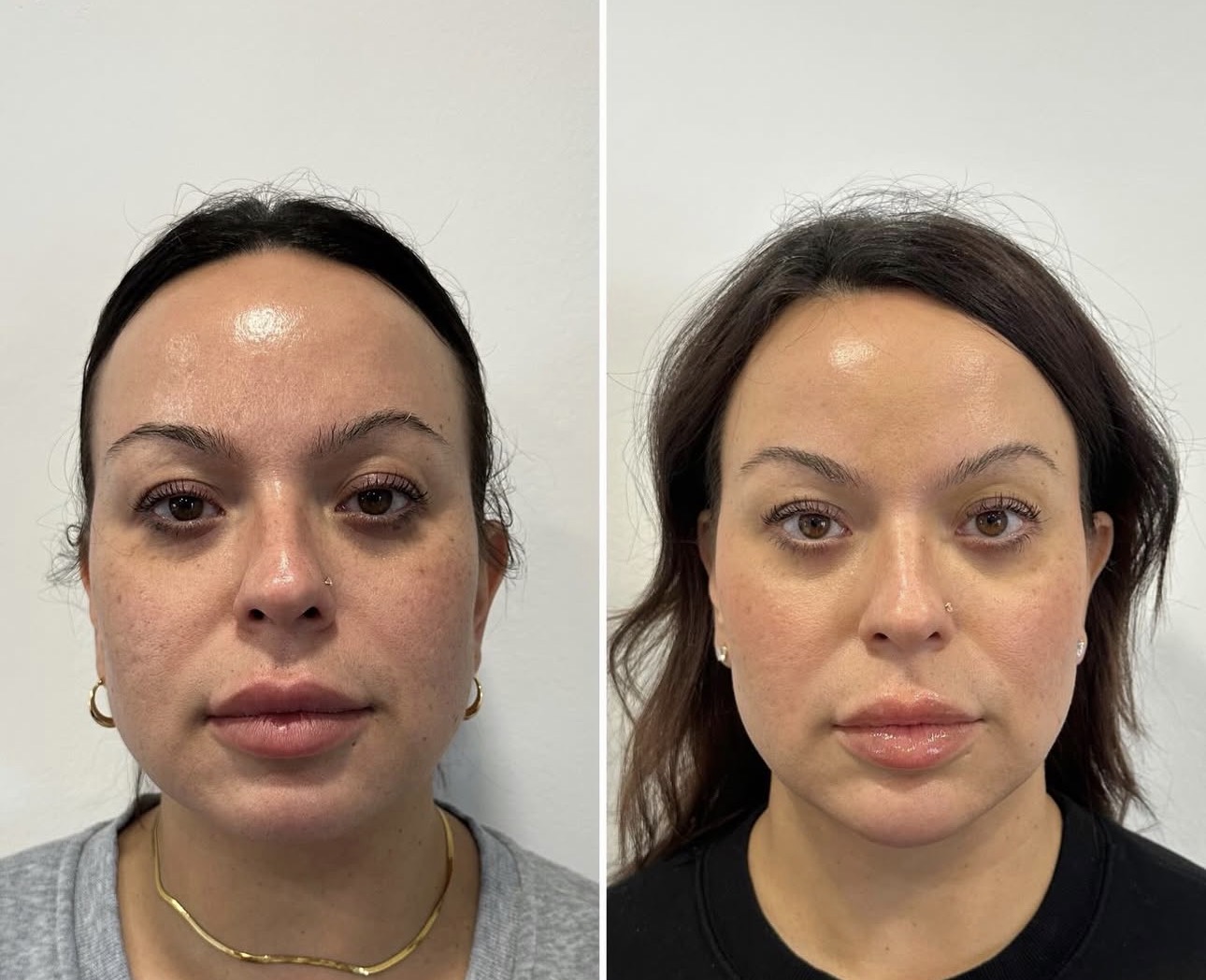 Facial rebalancing before and after — Skin House Birmingham