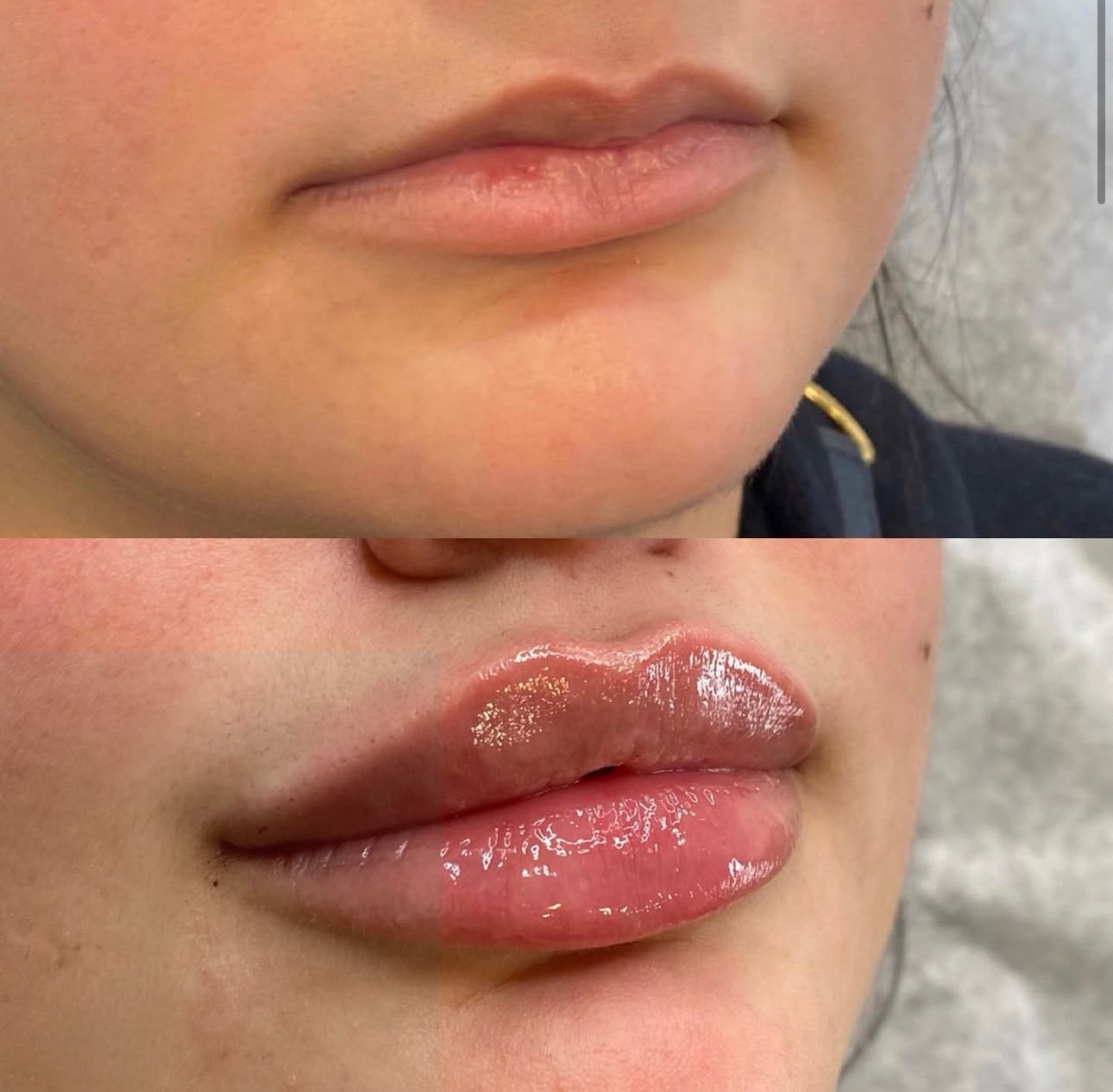 Lip filler before and after — Skin House Birmingham