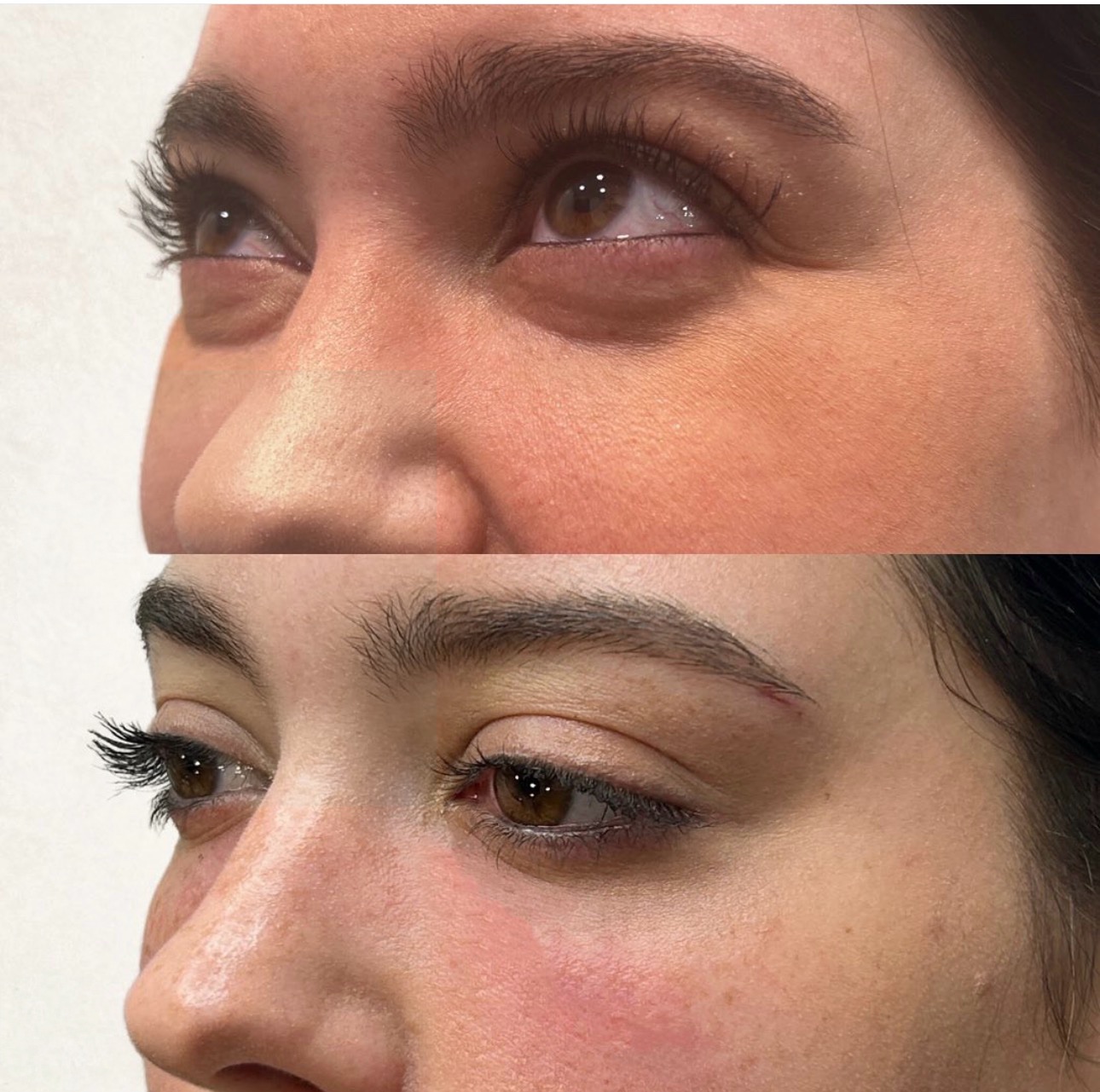 Under eye filler before and after — Skin House Birmingham