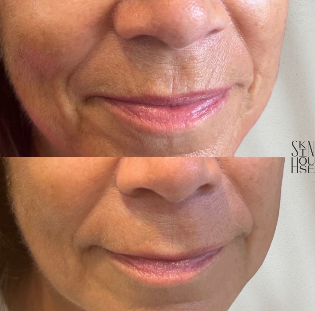 Before and after Botox for smile lines at Skin House Birmingham MI